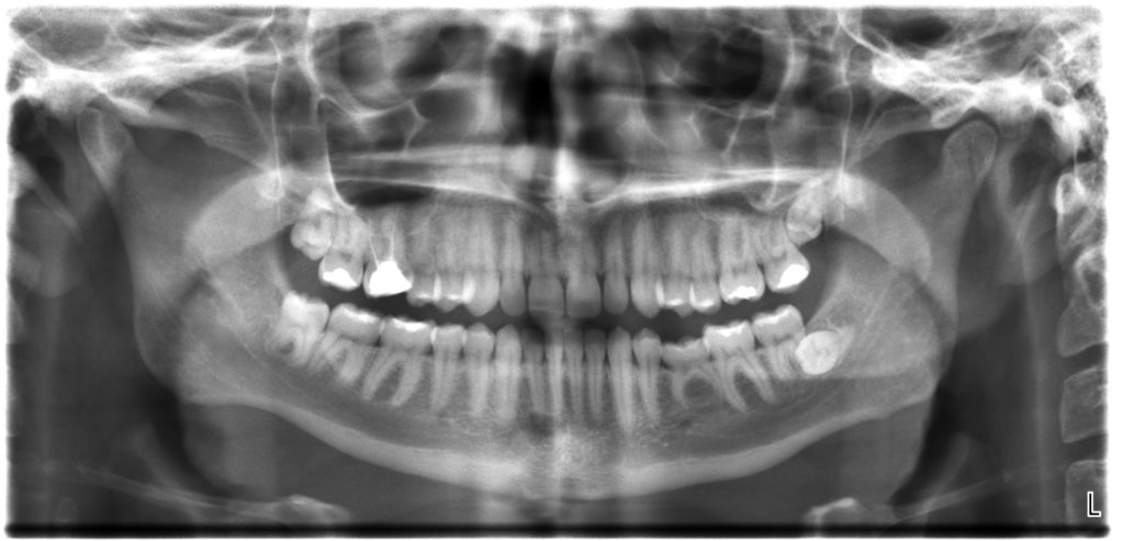 Dental_X-rays